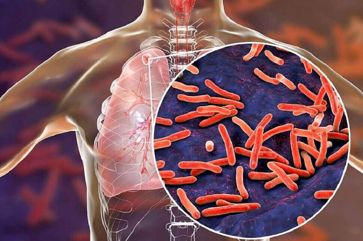 TBC Atau Tuberculosis Juga Bisa disebabkan seringnya terpapar angin malam