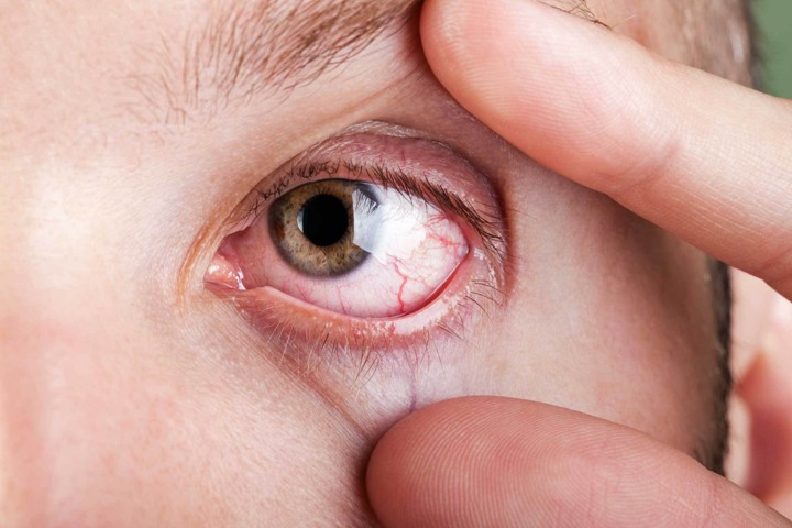 Penggunaan Gadget yang Berlebihan Berbahaya Untuk Kesehatan Mata