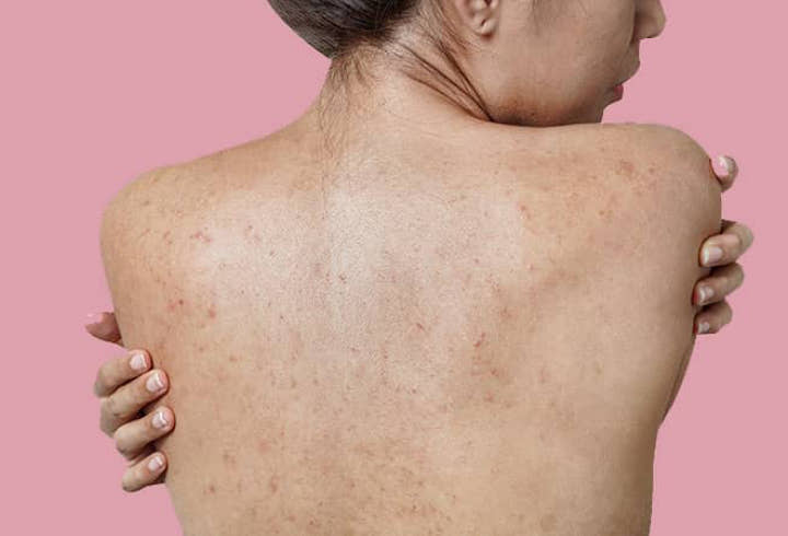 Body Lotion Dapat Mencegah Masalah Kulit Terutama Jerawat