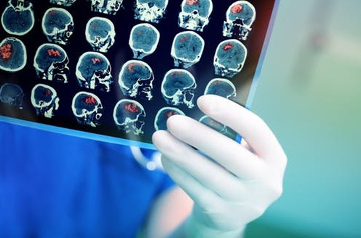 Jangan Suka Marah-Marah, Karena Bisa Menyebabkan Penyakit Stroke!