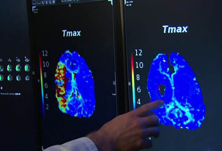 Yang Terparah, Membunyikan Tulang Dapat Menimbulkan Stroke