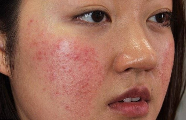 Kemunculan Ruam di Wajah Bisa Jadi Tanda Alergi Kosmetik