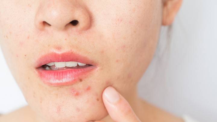 Alergi Kosmetik Biasanya Ditandai dengan Kulit Berminyak dan Wajah Berjerawat