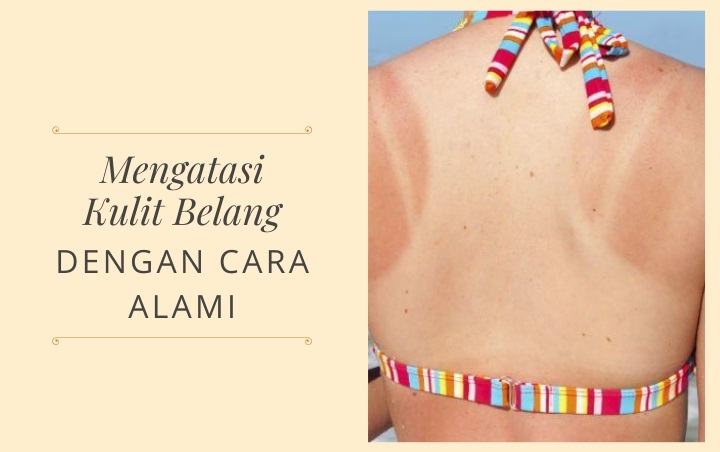 Bebas Bahan Kimia, Ikuti 7 Tips Ini Untuk Mengatasi Kulit Belang Dengan Cara Alami