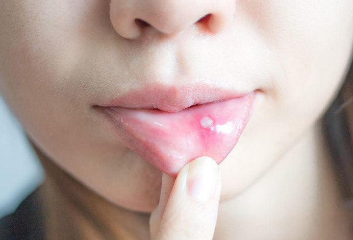 Mengunyah Dengan Cepat Bisa Melukai Bibir Dan Menimbulkan Sariawan