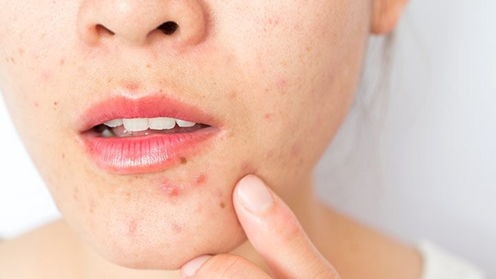 Punya Banyak Jerawat yang Membandel? Coba Atasi dengan Air Mawar