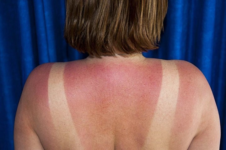 Ringankan Kulit yang Terbakar atau Sunburn dengan Menggunakan Air Mawar