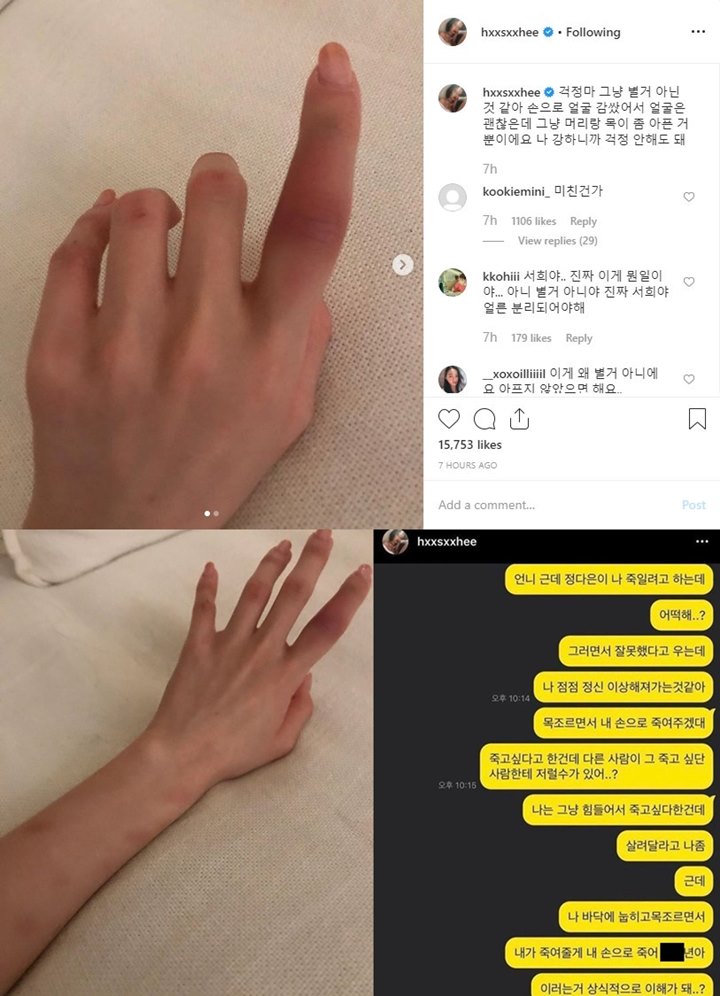 Han Seo Hee Posting Foto Lebam, Beber Hampir Dibunuh Pacar Transgender