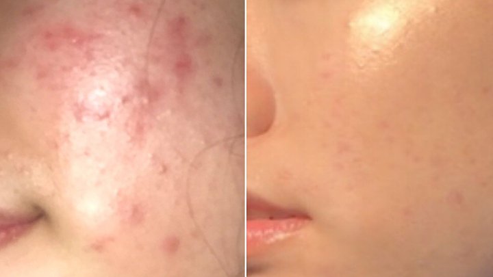 Sebal dengan Kemunculan Jerawat di Wajah? Atasi Saja dengan Menggunakan Masker Beras