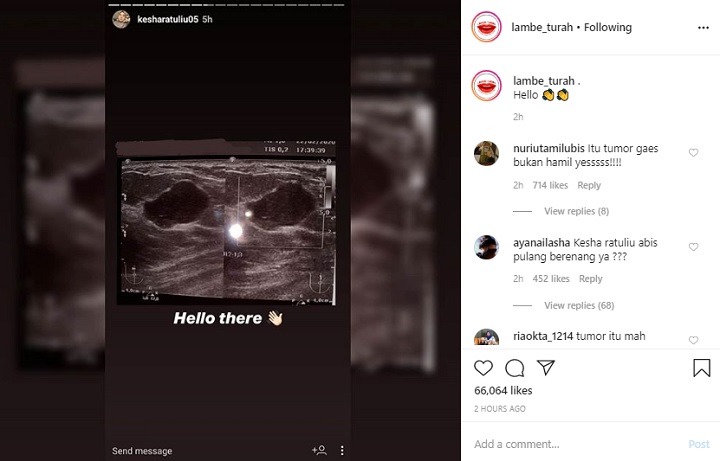 Kesha Ratuliu Bagikan Foto USG Padahal Belum Menikah