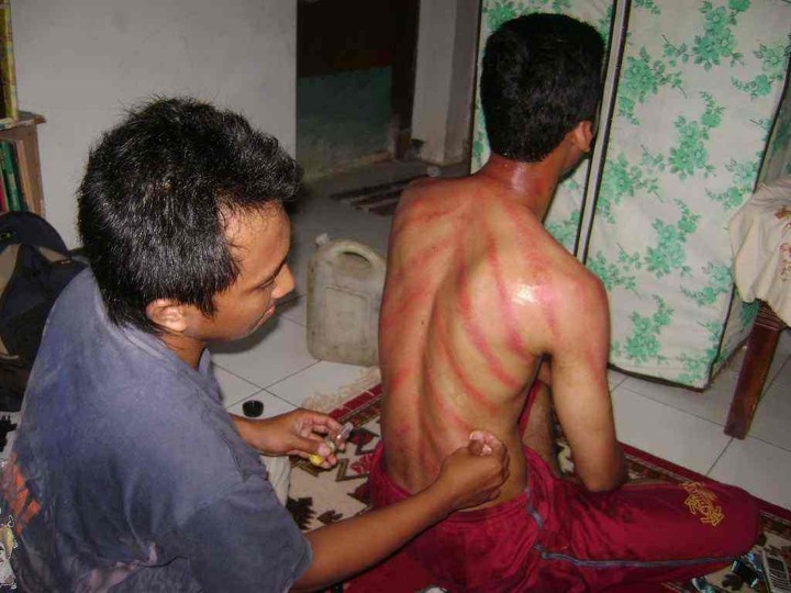Kerokan Aman Dilakukan Selama Tidak Berlebihan