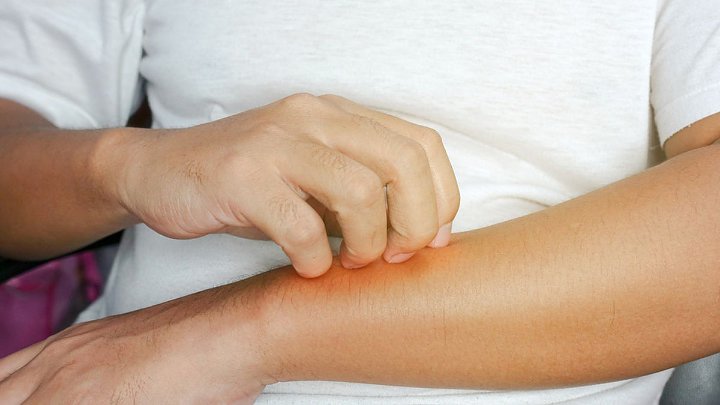 Meminum Antibiotik Tanpa Arahan Dokter Juga Bisa Picu Alergi