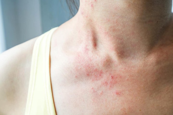 Rawan Terkena Infeksi Jamur Juga Jadi Salah Satu Bahaya Konsumsi Antibiotik Semabarangan