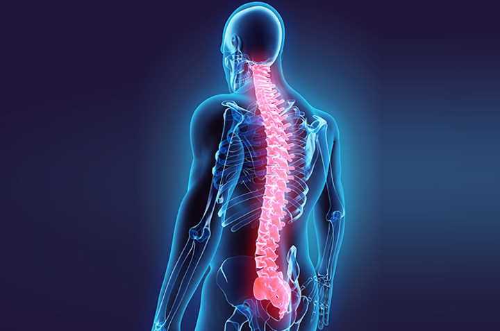 Multiple Sclerosis Penyakit Autoimun Yang Serang Sel Saraf Pusat