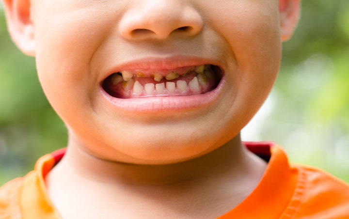 Orangtua Wajib Tahu! Ini 7 Penyebab Karies Gigi Pada Anak yang Harus Diwaspadai