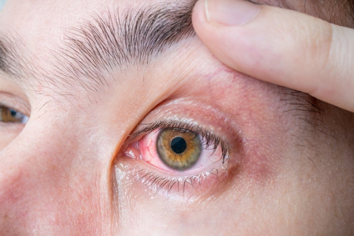 Hindari Memakai Softlens Terlalu Lama
