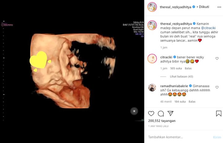 Rezky Aditya Bagikan Foto USG Buah Hatinya dengan Citra Kirana