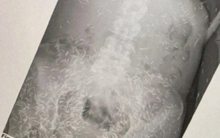 Heboh Penampakan 'Benda Gaib' Susuk Terekam X-Ray, Begini Penjelasan Pakar Radiologi