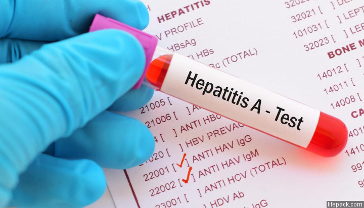 Hepatitis A