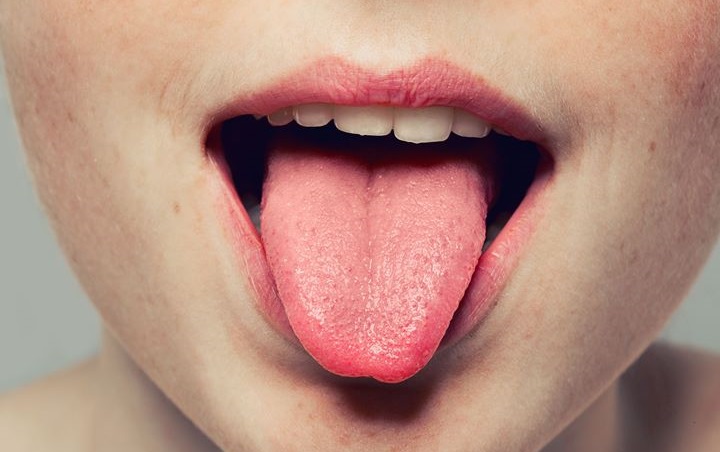 Perhatikan! Kini Benjolan Kecil di Lidah Juga Dikaitkan dengan Gejala COVID-19