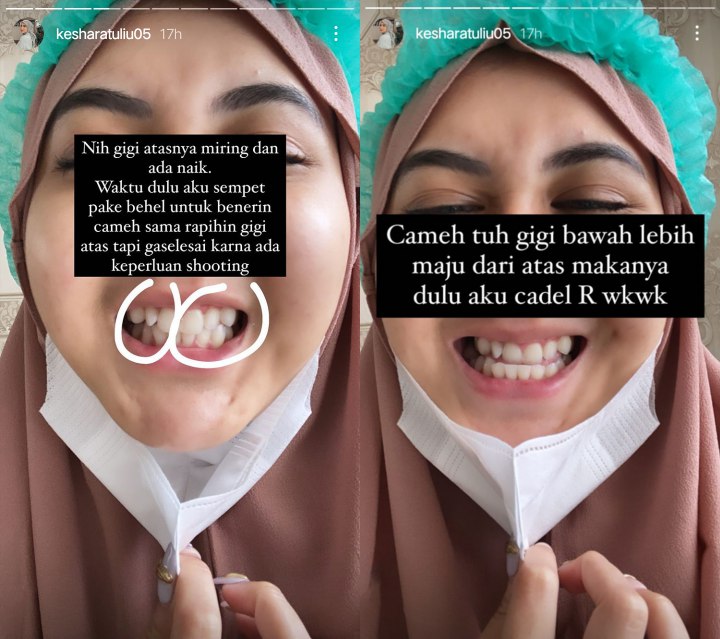 Kesha Ratuliu Kesal Dilarang-larang Veener Gigi, Minta Netizen Tak Ikut Campur