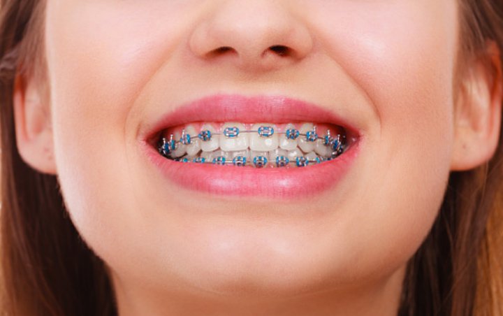 Sabar Dan Disiplin, Ini 7 Tips Perawatan Gigi Saat Pasang Behel Agar Hasilnya Lebih Maksimal!