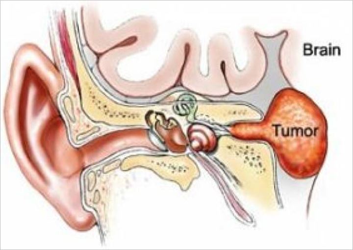 Neuroma Akustik