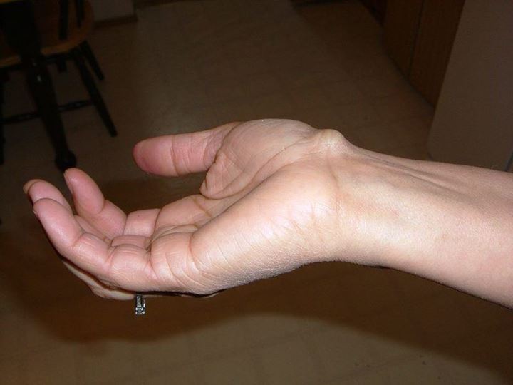 Kista Ganglion