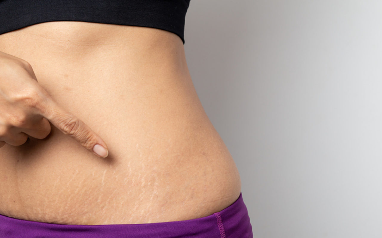 7 Rekomendasi Produk Penghilang Stretch Mark Yang Menganggu, Cocok