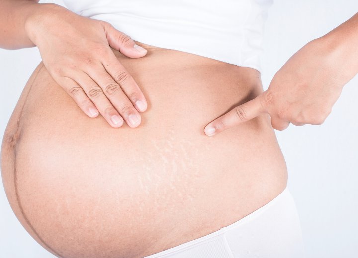 Cermat Saat Memilih Produk yang Mencegah Stretch Mark