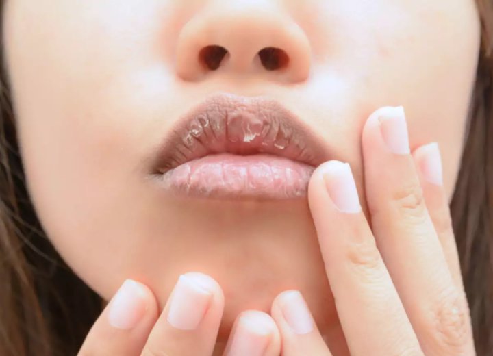 Bibir Kering dan Pecah-Pecah
