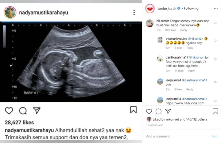 Nadya Istri Rizki DA Pamer Hasil USG, Potret Posisi Tangan Calon Bayi Jadi Sorotan