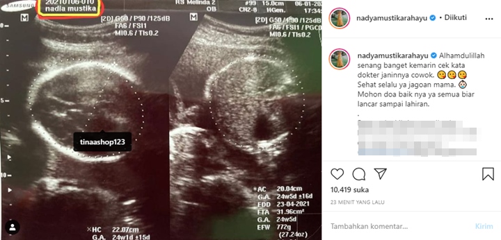 Nadya Istri Rizki DA Umumkan Jenis Kelamin Calon Bayi hingga Perkiraan Tanggal Lahir