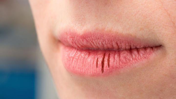  Ujung Bibir Pecah-Pecah