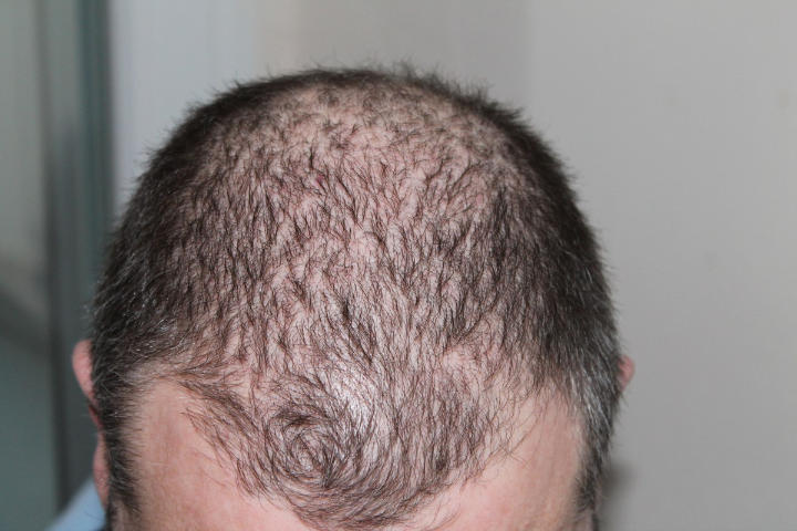 Rambut Rontok