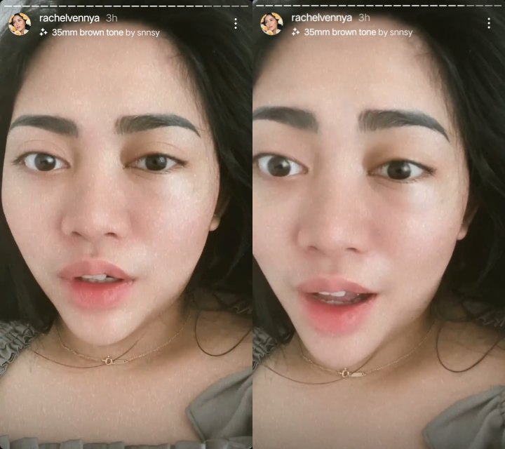 Mata Hingga Wajah Rachel Vennya Mendadak Bengkak Bikin Khawatir, Ada Apa?