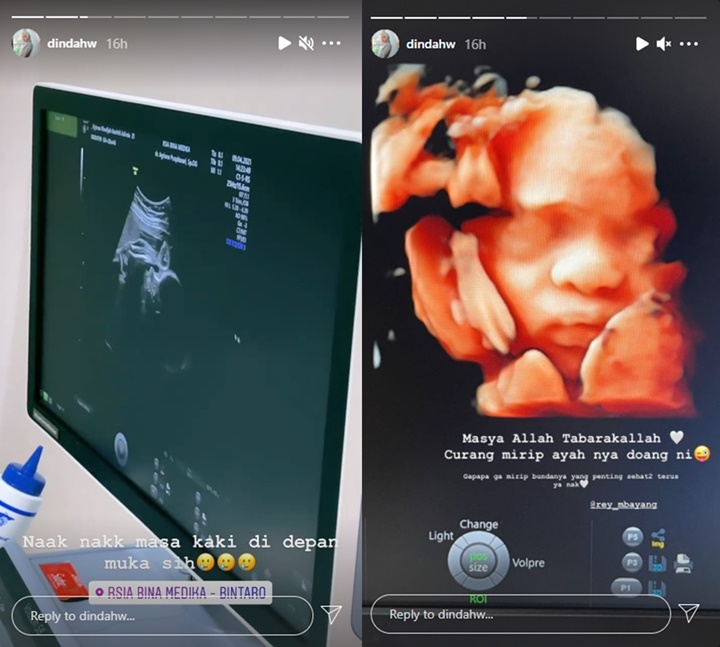 Dinda Hauw Pamer Foto USG Sang Bayi Mirip Rey Mbayang, Nama Calon Anak Terungkap?