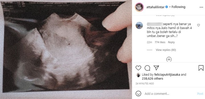 Aurel Hermansyah Keguguran, Netizen Singgung Mitos Hingga ...