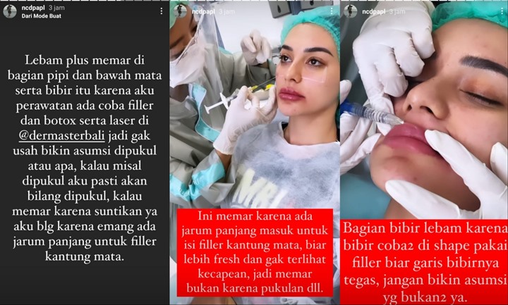 Wajah Nora Alexandra Lebam Diduga Karena Pukulan, Begini Faktanya