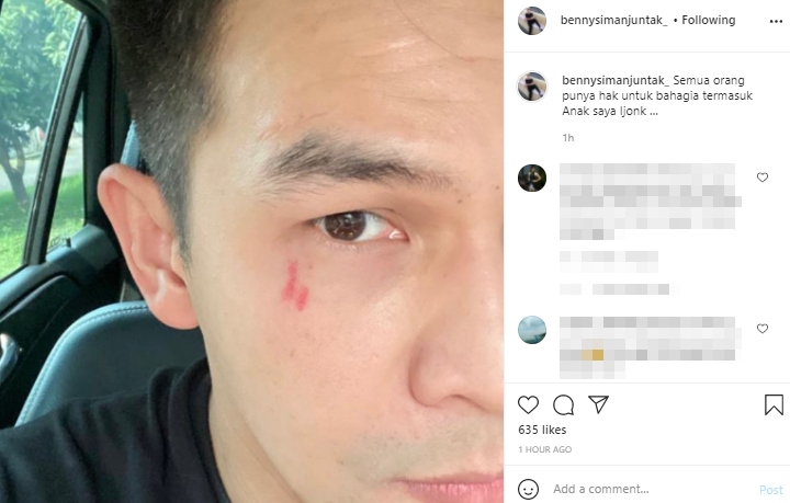 Potret Jonathan Frizzy Terluka di Bagian Bawah Mata \'Bukti KDRT Istri\' Disebar