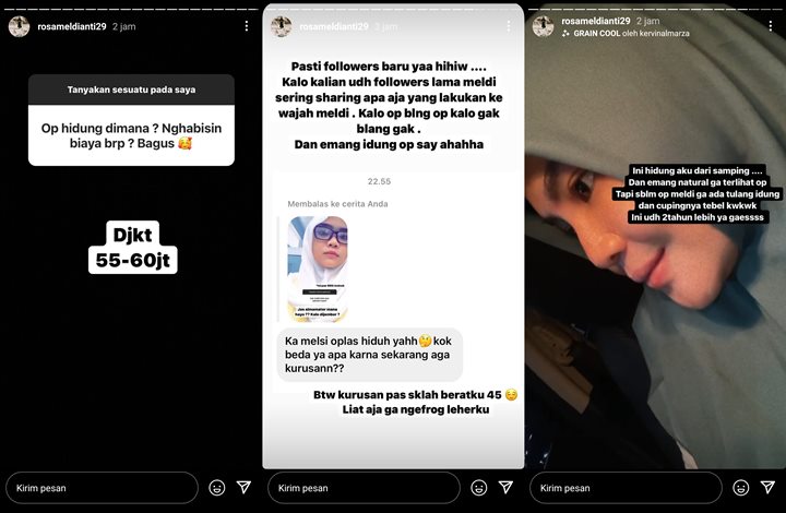 Rosa Meldianti Akui Operasi Hidung, Hasil Natural Habiskan Biaya 60 Juta