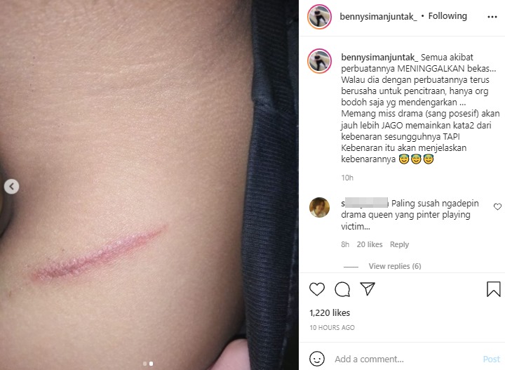 Bekas Luka di Tubuh Jonathan Frizzy Kembali Terungkap