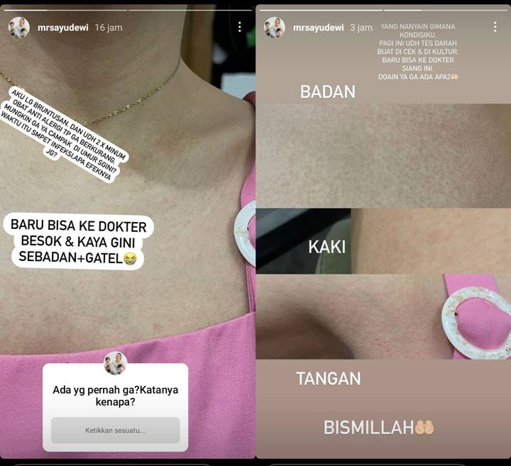 Sekujur Tubuh Ayu Dewi Gatal dan Muncul Bercak Merah, Takut Efek dari Infeksi