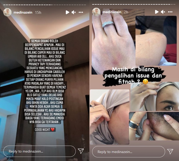 Dibilang Pengalihan Isu, Medina Zein Kembali Tunjukkan Bukti KDRT Lebih Parah