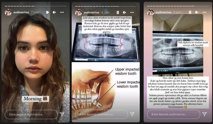 Audi Marissa Ungkap Penyebab Pipi Kanan-Kiri Bengkak, Foto Gemas Bak \'Chipmunk\' Dipuji Tetap Cantik