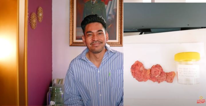 Operasinya Berhasil, Robby Purba Perlihatkan Penampakan Tumor Payudaranya yang Sudah Diangkat