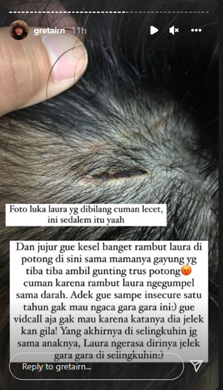 Ibunda Gaga Muhammad Sebut Cuma Lecet, Ternyata Begini Penampakan Luka Di Kepala Laura Anna