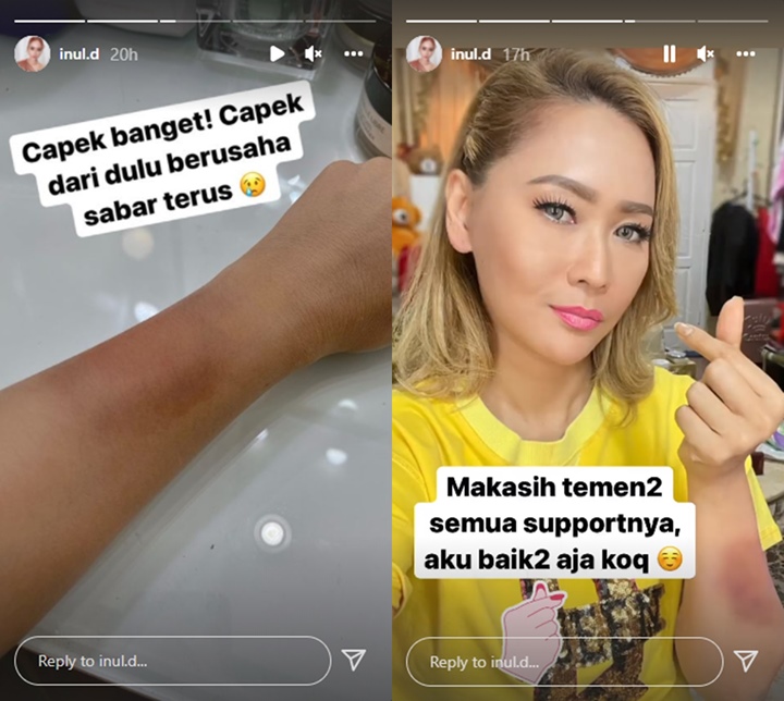 Inul Daratista Mendadak Tunjukkan Luka Memar Bikin Netter Suudzon, Ada Apa?