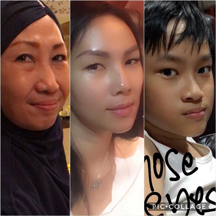 Foto Komplikasi Kemiripan