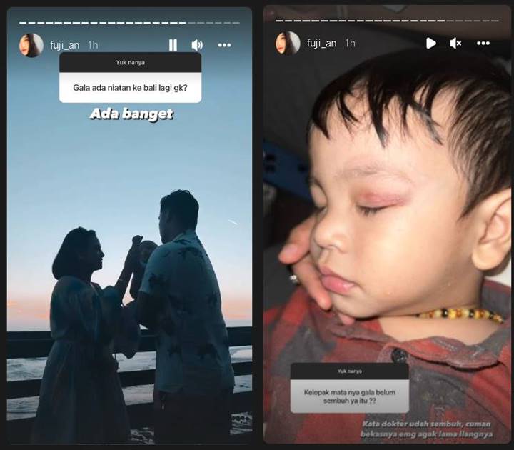 Fuji Bahas Kondisi Mata Gala yang Sempat Alami Luka Pascakecelakaan, Ungkap Penjelasan Dokter